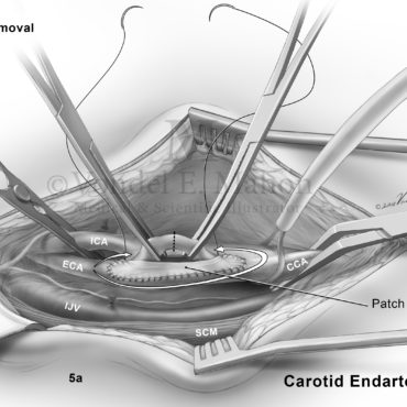 left carotid endarterectomy with patch angioplasty icd 10